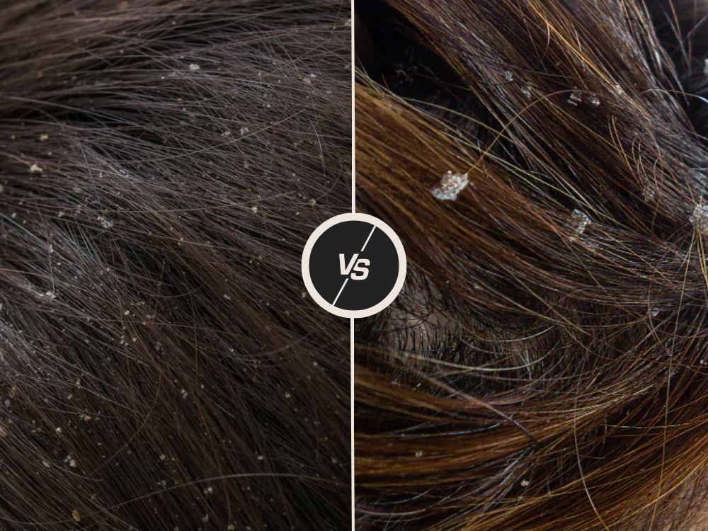 Dandruff VS Dry Scalp